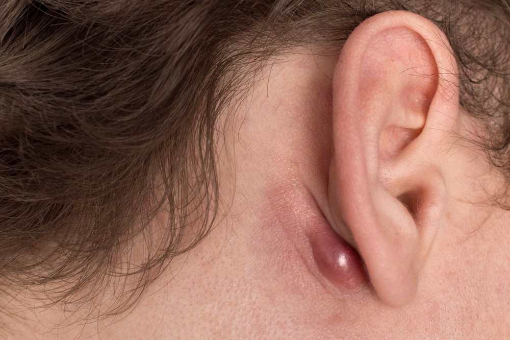Caucasian,Man,Haves,-,Cysts,Behind,The,Ear,-,Inflammation Swelling behind person's ear