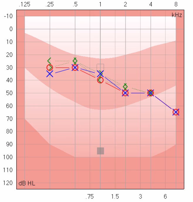 Sensorineural hearing loss